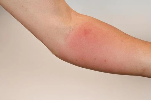 軽度な腫れと痒みの対処法